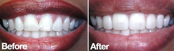 Before and After Cosmetic Gallery - Cosmetic Dentistry is dentistry aimed at creating a positive change in your teeth and your smile. San Francisco Cosmetic Dentists Dr. Kandar & Dr. Mak believe that Cosmetic Dentistry must complement the overall general and oral health of the patient. Please don't hesitate to reach out via our website, and request to schedule a free cosmetic consultation! Before and After Cosmetic Gallery - Cosmetic Dentistry is dentistry aimed at creating a positive change in your teeth and your smile. San Francisco Cosmetic Dentists Dr. Kandar & Dr. Mak believe that Cosmetic Dentistry must complement the overall general and oral health of the patient. Please don't hesitate to reach out via our website, and request to schedule a free cosmetic consultation!