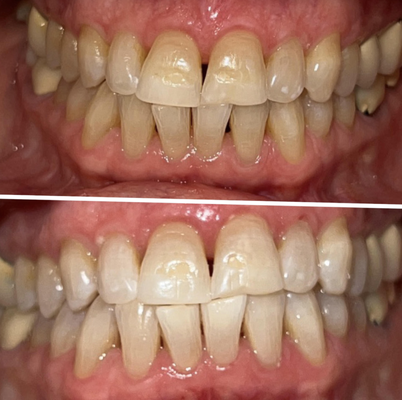 LED/Laser Whitening results - LED/Laser Whitening results. Give us a call today to book an appointment! LED/Laser Whitening results - LED/Laser Whitening results. Give us a call today to book an appointment!