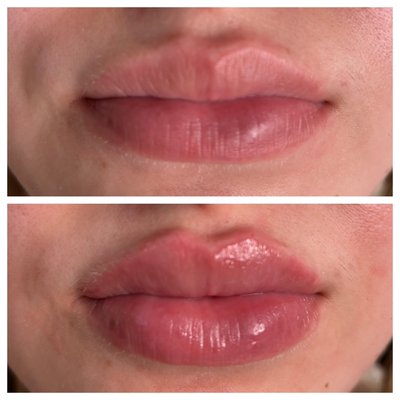 Lip Augmentation - Enhance your lips naturally by a subtle use of perfectly placed lip fillers. Lip Augmentation - Enhance your lips naturally by a subtle use of perfectly placed lip fillers.