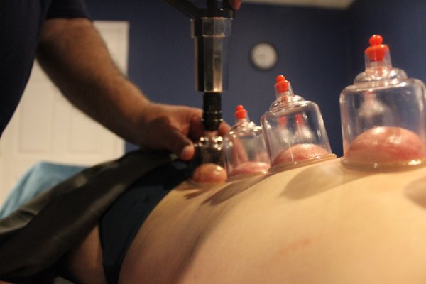 Cupping - One of the old and most effective methods to release adheatinn between muscles layers and the superficial fascia.it is very helpful to increase the range of motion of joints. Cupping - One of the old and most effective methods to release adheatinn between muscles layers and the superficial fascia.it is very helpful to increase the range of motion of joints.