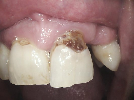 May, 2025 Repair front teeth! - This patient had some large cavities on his front teeth and was missing a front tooth. He has a great smile now! May, 2025 Repair front teeth! - This patient had some large cavities on his front teeth and was missing a front tooth. He has a great smile now!
