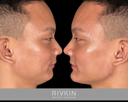 Jawline enhancement - The jaw line is the defining feature of the lower face. A chin or jaw line that recedes or lacks definition can impact the facial shape and overall harmony of the facial features. A narrow jaw can appear less masculine; a receding jaw/chin can take away from a feminine or heart-shaped face. Filler injections can be used for non-surgical jaw or chin enhancements. Using fillers can add definition and volume to the jaw line without implants or surgery, creating the face shape you desire. Jawline enhancement - The jaw line is the defining feature of the lower face. A chin or jaw line that recedes or lacks definition can impact the facial shape and overall harmony of the facial features. A narrow jaw can appear less masculine; a receding jaw/chin can take away from a feminine or heart-shaped face. Filler injections can be used for non-surgical jaw or chin enhancements. Using fillers can add definition and volume to the jaw line without implants or surgery, creating the face shape you desire.