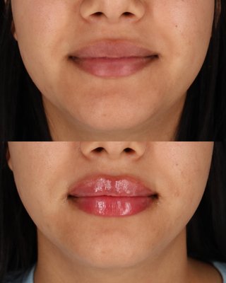 Lip rejuvenation - Thoughtfully placed lip filler can restore lost volume, improve symmetry, define the lip border, or create subtle enhancement while maintaining a soft, natural appearance.
Every treatment is customized to your facial proportions and aesthetic goals. Whether you're looking for gentle hydration, improved definition, or a fuller lip, our philosophy is always the same: enhance your natural features without creating an overfilled look. Lip rejuvenation - Thoughtfully placed lip filler can restore lost volume, improve symmetry, define the lip border, or create subtle enhancement while maintaining a soft, natural appearance.
Every treatment is customized to your facial proportions and aesthetic goals. Whether you're looking for gentle hydration, improved definition, or a fuller lip, our philosophy is always the same: enhance your natural features without creating an overfilled look.
