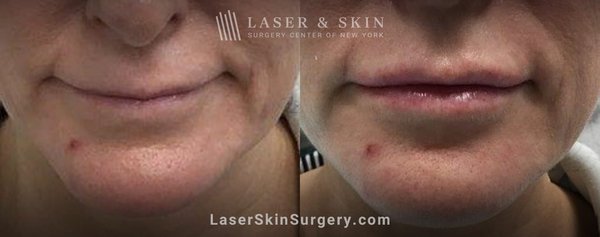 Dermal Fillers Before & Afters - All our dermal filler injections are conducted by board-certified dermatologists who have the training and experience necessary to deliver beautiful, natural-looking results with injectables. Whenever you come to us for cosmetic treatment, you can be confident that you’ll leave our office looking refreshed and rejuvenated with minimal recovery time. Dermal Fillers Before & Afters - All our dermal filler injections are conducted by board-certified dermatologists who have the training and experience necessary to deliver beautiful, natural-looking results with injectables. Whenever you come to us for cosmetic treatment, you can be confident that you’ll leave our office looking refreshed and rejuvenated with minimal recovery time.