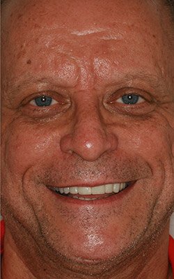 Crowns, Bridges & Implants - If restorative treatment is necessary, it is important to Dr. Hawk that the patient understands all of the treatment options. In addition to our patient's comfort, restoring a healthy look and feel of your teeth is our greatest concern. We use the finest material available in our restorations, which allows us to duplicate the color and contours of the teeth.
Our crowns, bridges and implants come with a 10 year warranty! Crowns, Bridges & Implants - If restorative treatment is necessary, it is important to Dr. Hawk that the patient understands all of the treatment options. In addition to our patient's comfort, restoring a healthy look and feel of your teeth is our greatest concern. We use the finest material available in our restorations, which allows us to duplicate the color and contours of the teeth.
Our crowns, bridges and implants come with a 10 year warranty!