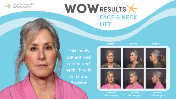 Facelift and Neck Lift - From sagging skin and deep facial folds to jowls and loss of jawline definition, facelift and neck lift can totally rejuvenate the face and neck and make you look an average of 10 years younger. Here are before and after photos of face and neck lift results by the board-certified plastic surgeons at La Jolla Cosmetic Surgery Centre in La Jolla, CA. Facelift and Neck Lift - From sagging skin and deep facial folds to jowls and loss of jawline definition, facelift and neck lift can totally rejuvenate the face and neck and make you look an average of 10 years younger. Here are before and after photos of face and neck lift results by the board-certified plastic surgeons at La Jolla Cosmetic Surgery Centre in La Jolla, CA.