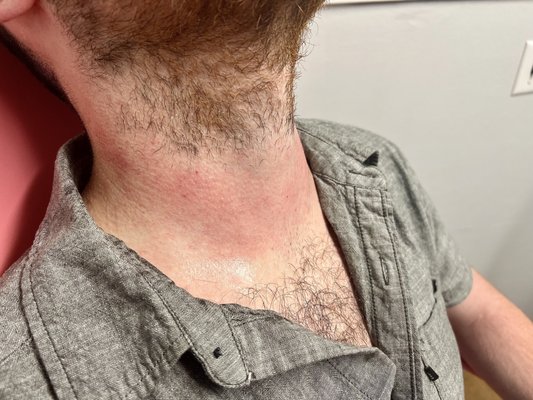 Laser Hair Removal - This client was concerned with his neck hair. He was sick of shaving all the way down his neck. He also experiences a lot of razor bumps and occasional ingrown hairs, the laser has removed all of it! Laser Hair Removal - This client was concerned with his neck hair. He was sick of shaving all the way down his neck. He also experiences a lot of razor bumps and occasional ingrown hairs, the laser has removed all of it!