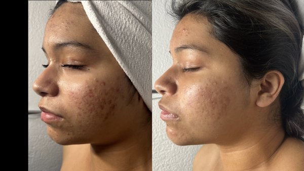 Acne Bootcamp - One of our Lovely clients has been struggling with acne for a while and we were able to customize a chemical peel package tailored to her needs and skin type to help calm down her breakouts and reduce inflammation and hyperpigmentation. Acne Bootcamp - One of our Lovely clients has been struggling with acne for a while and we were able to customize a chemical peel package tailored to her needs and skin type to help calm down her breakouts and reduce inflammation and hyperpigmentation.