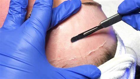 Derma Planing - Dermaplaning is a procedure that exfoliates your skin and gets rid of dirt and vellus hair, better known as “peach fuzz.”