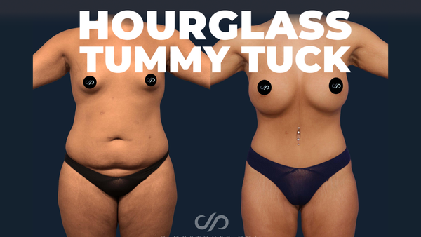 Tummy Tuck - Loose skin, stretch marks and fat on the abdomen are among the most common reasons people seek help from a plastic surgeon. In some cases, they have excess skin and fat on the abdomen from significant weight loss. In other cases, age or pregnancy has changed the contour of the abdomen. Many are frustrated that diet and exercise do not tighten their lower abdominal skin. Some even lose the motivation to exercise because they can't see their muscles underneath their loose skin. For many women and men, the best way to reclaim a youthful form is with a tummy tuck in my Los Angeles practice.