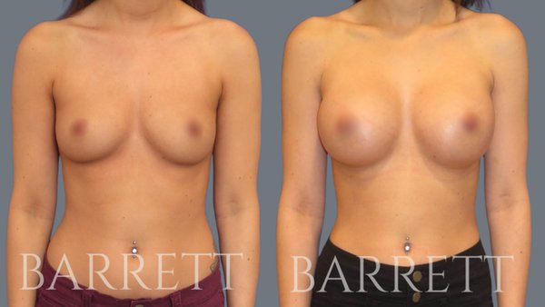 Breast Augmentation With Implants - Breast augmentation with implants is one of the most common cosmetic procedures worldwide. Performed to enhance the breast's size and shape, patients have various implant types and incision techniques to achieve their breast goals. Breast augmentation with implants is an excellent choice for patients desiring fuller breasts. Whether following a reduction in volume or size after pregnancy, correcting a congenital breast defect, or balancing breast size, this procedure can achieve a wide variety of unique goals. Dr. Barrett is a world renowned board-certified plastic surgeon in Beverly Hills, California. He specializes in aesthetic and reconstructive surgery of the face, breast, and body.