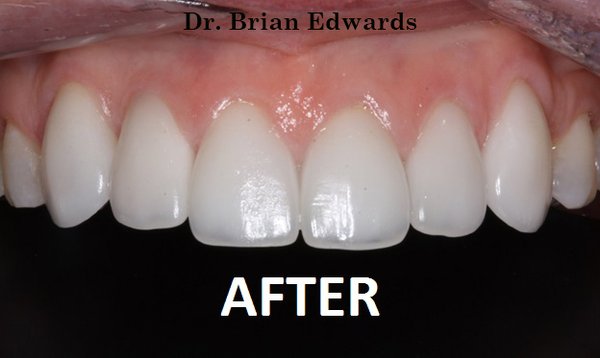 Dental Implants - This is an example of a dental implant on our patients front tooth.  We use the best materials and ceramists to achieve ideal results.