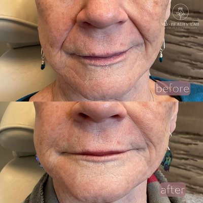 Filler - Our expert injectors use a wide range of fillers to smooth out fine lines and wrinkles, restore volume, sculpt facial features, and hydrate the skin.