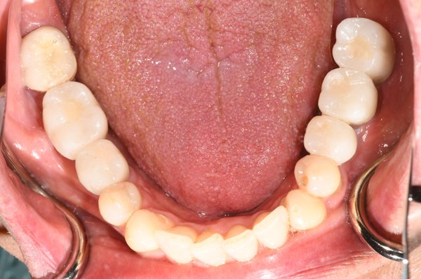 Dental Implants - This patient was missing his teeth for many years. He decided that he wanted to make an investment to improve his ability to chew and to replace his removable denture that he had been using. His missing spaces were restored with five dental implants to replace his missing teeth. Dental Implants - This patient was missing his teeth for many years. He decided that he wanted to make an investment to improve his ability to chew and to replace his removable denture that he had been using. His missing spaces were restored with five dental implants to replace his missing teeth.