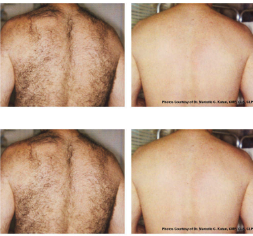 Laser Treatments - With Gentle Pro's removal system you can remove or reduce the appearance of...
Unwanted Hair
Freckles
Sun and Age spots
Diffuse red skin
Leg and facial spider veins
Deep blue leg veins
Wrinkles Laser Treatments - With Gentle Pro's removal system you can remove or reduce the appearance of...
Unwanted Hair
Freckles
Sun and Age spots
Diffuse red skin
Leg and facial spider veins
Deep blue leg veins
Wrinkles