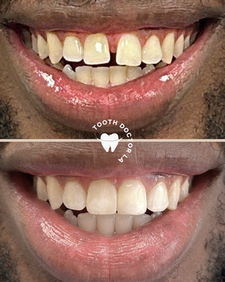 Smile Makeovers - We are proud to be able to offer all the treatments you need to get the smile you want here with us at Tooth Doctor LA. With the likes of Invisalign, teeth whitening, composite bonding, veneers and more available - you can get a full smile makeover here in our comfortable and modern office with our friendly and professional in Beverly Hills. Smile Makeovers - We are proud to be able to offer all the treatments you need to get the smile you want here with us at Tooth Doctor LA. With the likes of Invisalign, teeth whitening, composite bonding, veneers and more available - you can get a full smile makeover here in our comfortable and modern office with our friendly and professional in Beverly Hills.
