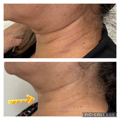 I offer Jet Plasma, Fibroblast spot treatment, microneedling, Peels, Radiofrequency, Laser Lipo, BBL, Ultrasound Cavitation , Vacuum Therap - Offer several services contact me for more info I offer Jet Plasma, Fibroblast spot treatment, microneedling, Peels, Radiofrequency, Laser Lipo, BBL, Ultrasound Cavitation , Vacuum Therap - Offer several services contact me for more info