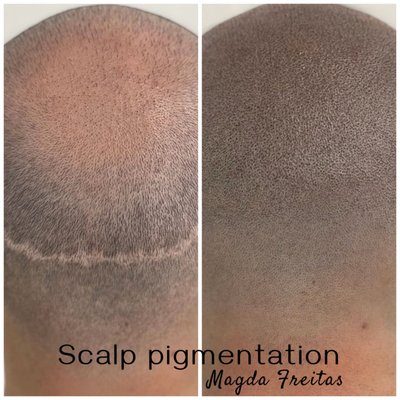 Scalp Micropigmentation - Scalp Micropigmentation is a permanent makeup or cosmetic tattooing procedure that uses tiny pigments to create the illusion of hair in the Scalp it can even camouflage scars and other skin imperfections. It's essentially a form of tattooing, but with specific techniques and pigments designed for cosmetic purposes. Scalp Micropigmentation - Scalp Micropigmentation is a permanent makeup or cosmetic tattooing procedure that uses tiny pigments to create the illusion of hair in the Scalp it can even camouflage scars and other skin imperfections. It's essentially a form of tattooing, but with specific techniques and pigments designed for cosmetic purposes.