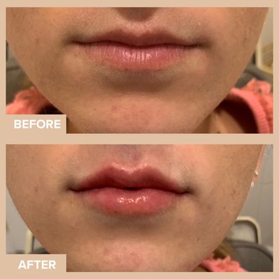 Lip Fillers Before And After - Here are some of our previous clients who came in for lip fillers. #lipfillers