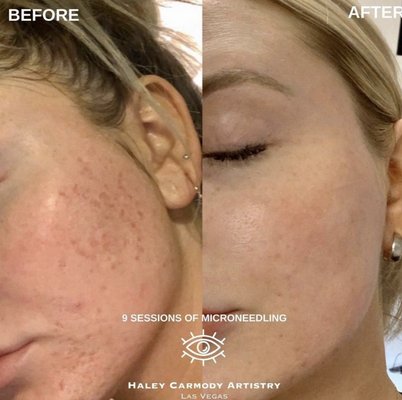 MICRONEEDLING FOR ACNE SCARS - MICRONEEDLING FOR ACNE SCARS

Not the prettiest post I’ve ever shared, but whatever! The top photo is March 2020, wearing make up but can totally still see my texture & scars - the bottom photo is March 2021 with no makeup on in direct sunlight! 10 sessions of microneedling in between these 2... Swipe to see where my skin started right after I stopped breaking out! The difference being consistent with Microneedling can give the skin will never stop amazing me.

💲150 for a single session (discounted packages available)

💉 Zero downtime, redness lasts up to 72 hrs or less, heals very similar to a sunburn

📲 text 702-918-5057 for booking/more info

📍Locations in Las Vegas and San Diego