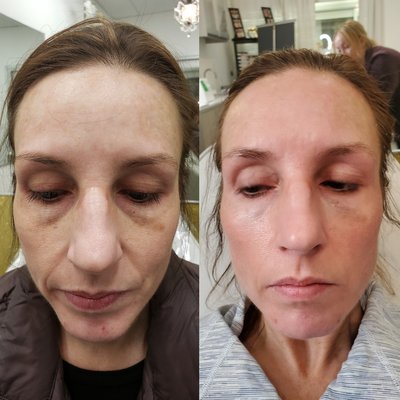 Microneedling - Microneedling, or collagen induction therapy, is he latest trend in this quest to stay youthful. It's a minimally invasive procedure that uses fine needles to puncture the skin and create a controlled skin injury in order to rejuvenate skin. It is used to treat fine lines and wrinkles, lax/looses skin, acne scarring, large pores, sun spots and age spots, overall skin tone, scars, stretch mark and much more! Microneedling - Microneedling, or collagen induction therapy, is he latest trend in this quest to stay youthful. It's a minimally invasive procedure that uses fine needles to puncture the skin and create a controlled skin injury in order to rejuvenate skin. It is used to treat fine lines and wrinkles, lax/looses skin, acne scarring, large pores, sun spots and age spots, overall skin tone, scars, stretch mark and much more!