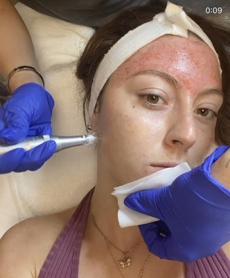 Microneedling Services! - Microneedling uses collagen induction therapy to create a minor puncture to the skin using microscopic needles, ( we use medical grade numbing so you don't feel a thing!) this collagen induction therapy creates the generation of new skin aka collagen and elastin, rebuilding your natural barrier, effectively removing fine lines, improving pore size, erasing acne scars and giving you a more even overall complexion. Talk about a baby face! Microneedling Services! - Microneedling uses collagen induction therapy to create a minor puncture to the skin using microscopic needles, ( we use medical grade numbing so you don't feel a thing!) this collagen induction therapy creates the generation of new skin aka collagen and elastin, rebuilding your natural barrier, effectively removing fine lines, improving pore size, erasing acne scars and giving you a more even overall complexion. Talk about a baby face!
