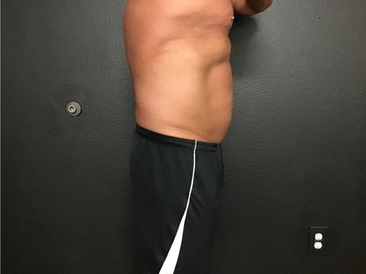 CoolSculpting - Before and after CoolSculpting treatments
