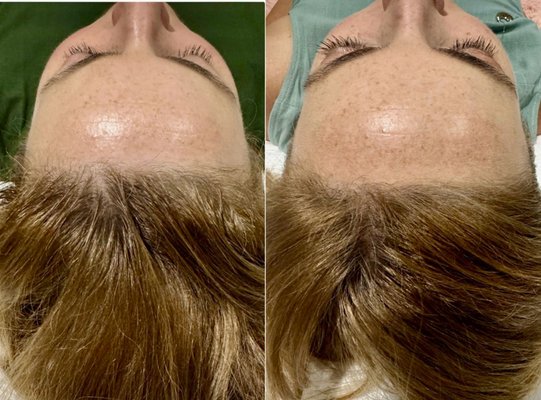 Hair Restoration 2024 - This image showcases the results of hairline restoration after two sessions of Microneedling with exosomes. The treatment has visibly enhanced the fullness of the hairline, promoting hair regrowth and thickness. Microneedling with exosomes stimulates the scalp, encouraging hair follicle activity and improving hair density. After just two sessions, the hairline looks noticeably fuller, indicating the effectiveness of this advanced treatment in addressing thinning hair and restoring a natural-looking hairline. Hair Restoration 2024 - This image showcases the results of hairline restoration after two sessions of Microneedling with exosomes. The treatment has visibly enhanced the fullness of the hairline, promoting hair regrowth and thickness. Microneedling with exosomes stimulates the scalp, encouraging hair follicle activity and improving hair density. After just two sessions, the hairline looks noticeably fuller, indicating the effectiveness of this advanced treatment in addressing thinning hair and restoring a natural-looking hairline.