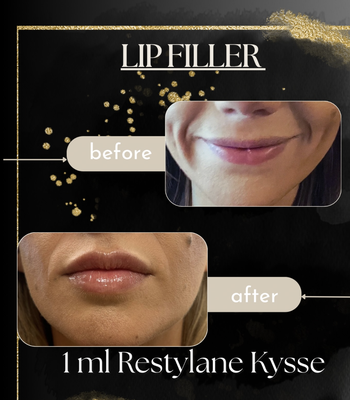 Before & After - At Radiant Heights Medsp we don't just treat skin, we transform confidence. Look at our quality work with our happy customers and let's get you scheduled today! Before & After - At Radiant Heights Medsp we don't just treat skin, we transform confidence. Look at our quality work with our happy customers and let's get you scheduled today!