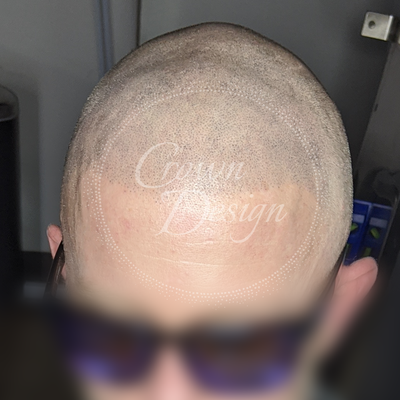 Men's Hairline. - Men's scalp pigmentation with recreated hairline. Men's Hairline. - Men's scalp pigmentation with recreated hairline.