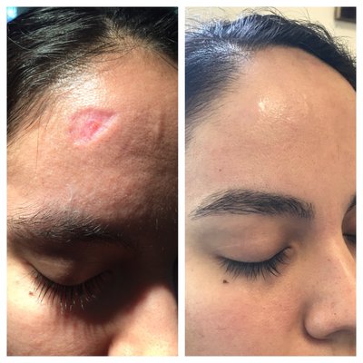 Scar Removal - 📞 Get in touch with us today — we’d love to help! Scar Removal - 📞 Get in touch with us today — we’d love to help!