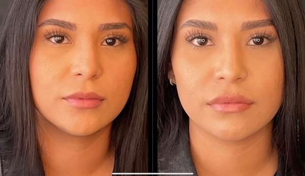 Before and After - Explore what customized skincare can look like with a few of our before and after images showcasing the transformative power of our advanced cosmetic treatments at dermani MEDSPA®. Witness the remarkable results achieved by our skilled team through treatments such as BOTOX®, JUVÉDERM® fillers, laser therapies, and more. Each image tells a story of renewed confidence, enhanced natural beauty, and youthful radiance. Let our portfolio inspire you to take the next step towards achieving your aesthetic goals and embracing a more vibrant, rejuvenated version of yourself. Welcome to a world where beauty meets artistry at dermani MEDSPA®.