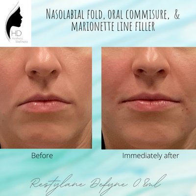 Filler (non-lip) - Hyaluronic acid filler is a substance injected into tissue of the face in order to smooth moderate to severe facial wrinkles and folds or shape facial contours. Filler treatments are customized for each patient depending on their particular need and can be performed in multiple areas. The use of anesthetics is often utilized to reduce discomfort associated with these procedures. The duration of the effect of dermal fillers injections is variable and temporary, usually lasting 6-24 months depending on product and metabolization rate of each individual. Filler (non-lip) - Hyaluronic acid filler is a substance injected into tissue of the face in order to smooth moderate to severe facial wrinkles and folds or shape facial contours. Filler treatments are customized for each patient depending on their particular need and can be performed in multiple areas. The use of anesthetics is often utilized to reduce discomfort associated with these procedures. The duration of the effect of dermal fillers injections is variable and temporary, usually lasting 6-24 months depending on product and metabolization rate of each individual.