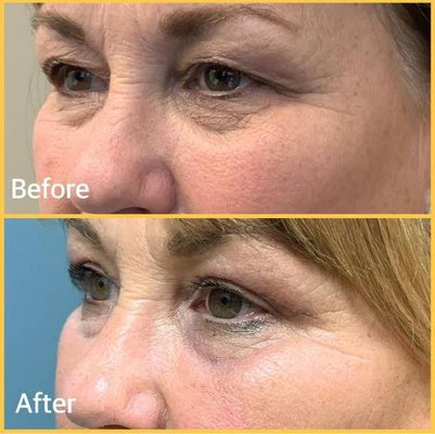 Blepharoplasty - With extensive experience in all Oral and Maxillo-Facial surgical procedures, Dr. Gilbert has been teaching other doctors for the past 20 years. Advanced training and a particular interest in the reconstruction of Oral and Facial deformities have fueled Dr. Gilbert’s passion for dental implant replacement of teeth, jaw reconstruction and orthognathic surgery, facial cosmetic, and reconstructive surgery.