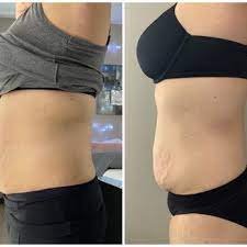 Body Contouring - Body Contouring enables you to safely achieve a toned, contoured and well shaped body. Body Contouring - Body Contouring enables you to safely achieve a toned, contoured and well shaped body.