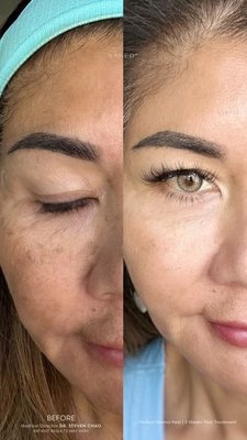 Perfect Derma Peel - Perfect Derma Peel Perfect Derma Peel - Perfect Derma Peel