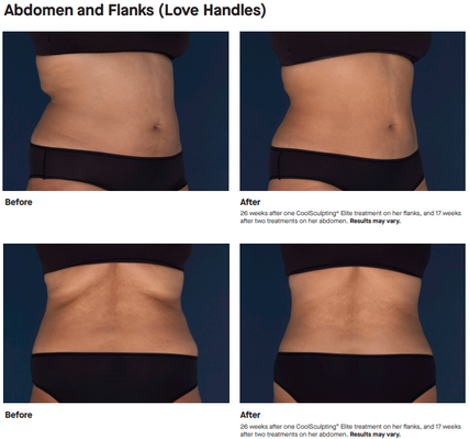 CoolSculpting® Elite B&A - CoolSculpting® and CoolSculpting® Elite Uses and Important Safety Information
Uses
CoolSculpting® and CoolSculpting® Elite are FDA-cleared for the treatment of visible fat bulges in
the submental (under the chin) and submandibular (under the jawline) areas, thigh, abdomen, and
flank, along with bra fat, back fat, underneath the buttocks (also known as banana roll), and upper
arm. It is also FDA-cleared to affect the appearance of lax tissue with submental area treatments.
CoolSculpting® and CoolSculpting® Elite are not treatments for weight loss.
Important Safety Information
This procedure is not for everyone. You should not be treated with CoolSculpting® or CoolSculpting®
Elite if you suffer from cryoglobulinemia, cold agglutinin disease, or paroxysmal cold hemoglobinuria.
Tell your doctor if you are pregnant or have any medical conditions including recent surgery,
pre-existing hernia, and any known sensitivities or allergies.
tingling, stinging, aching, cramping and discomfort at the treatment site. These sensations lessen as
the area becomes numb. Following the procedure, typical side effects include temporary redness,
swelling, blanching, bruising, firmness, stinging, tenderness, cramping, skin inflammation and aching.
Sensory alteration (itching, skin sensitivity, tingling, and numbness) can persist up to several weeks
after treatment. You may also experience throat discomfort/soreness and sensation of fullness in the
back of the throat after submental or submandibular area treatment.
Rare side effects may happen in 1 to 10 out of 10,000 CoolSculpting® and CoolSculpting® Elite
treatments (between 0.01% to 0.1%). One such rare side effect is a visible enlargement in the treated
area, which may develop 2 to 5 months after treatment, will not resolve on its own, and may require
surgical intervention for correction.
Please see full Important Safety Information for CoolSculpting® and CoolSculpting® Elite on
CoolSculpting.com. CoolSculpting® Elite B&A - CoolSculpting® and CoolSculpting® Elite Uses and Important Safety Information
Uses
CoolSculpting® and CoolSculpting® Elite are FDA-cleared for the treatment of visible fat bulges in
the submental (under the chin) and submandibular (under the jawline) areas, thigh, abdomen, and
flank, along with bra fat, back fat, underneath the buttocks (also known as banana roll), and upper
arm. It is also FDA-cleared to affect the appearance of lax tissue with submental area treatments.
CoolSculpting® and CoolSculpting® Elite are not treatments for weight loss.
Important Safety Information
This procedure is not for everyone. You should not be treated with CoolSculpting® or CoolSculpting®
Elite if you suffer from cryoglobulinemia, cold agglutinin disease, or paroxysmal cold hemoglobinuria.
Tell your doctor if you are pregnant or have any medical conditions including recent surgery,
pre-existing hernia, and any known sensitivities or allergies.
tingling, stinging, aching, cramping and discomfort at the treatment site. These sensations lessen as
the area becomes numb. Following the procedure, typical side effects include temporary redness,
swelling, blanching, bruising, firmness, stinging, tenderness, cramping, skin inflammation and aching.
Sensory alteration (itching, skin sensitivity, tingling, and numbness) can persist up to several weeks
after treatment. You may also experience throat discomfort/soreness and sensation of fullness in the
back of the throat after submental or submandibular area treatment.
Rare side effects may happen in 1 to 10 out of 10,000 CoolSculpting® and CoolSculpting® Elite
treatments (between 0.01% to 0.1%). One such rare side effect is a visible enlargement in the treated
area, which may develop 2 to 5 months after treatment, will not resolve on its own, and may require
surgical intervention for correction.
Please see full Important Safety Information for CoolSculpting® and CoolSculpting® Elite on
CoolSculpting.com.