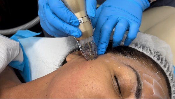 Sylfirm X- RF Microneedling - Soma Medical Spa is pleased to introduce Sylfirm X, the world's first FDA-approved pulsed wave and continuous wave radio frequency microneedling system. The minimally invasive skin rejuvenation solution significantly improves complexion imperfections, revealing healthier, more youthful-looking skin.
The Benefits of Sylfirm X Radio Frequency Microneedling :
● FDA-approved for all skin types
● Induces collagen and elastin production
● Promotes tissue recovery
● Reduces the appearance of fine lines and wrinkles
● Treats acne and acne scars
● Improves uneven skin tone and texture
● Lifts and tightens loose and sagging skin
● Shrinks abnormal blood vessels
● Treats melasma, rosacea, and redness
● Reduces the secretions of oil glands
● Improves appearance of enlarged pores
● Treats post-inflammatory hyperpigmentation
● Enhances scalp circulation, promoting hair regrowth
● Minimizes stretch marks
● Delivers noticeable, lasting results Sylfirm X- RF Microneedling - Soma Medical Spa is pleased to introduce Sylfirm X, the world's first FDA-approved pulsed wave and continuous wave radio frequency microneedling system. The minimally invasive skin rejuvenation solution significantly improves complexion imperfections, revealing healthier, more youthful-looking skin.
The Benefits of Sylfirm X Radio Frequency Microneedling :
● FDA-approved for all skin types
● Induces collagen and elastin production
● Promotes tissue recovery
● Reduces the appearance of fine lines and wrinkles
● Treats acne and acne scars
● Improves uneven skin tone and texture
● Lifts and tightens loose and sagging skin
● Shrinks abnormal blood vessels
● Treats melasma, rosacea, and redness
● Reduces the secretions of oil glands
● Improves appearance of enlarged pores
● Treats post-inflammatory hyperpigmentation
● Enhances scalp circulation, promoting hair regrowth
● Minimizes stretch marks
● Delivers noticeable, lasting results