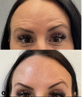 Botox - Ready to soften your facial expressions? Then it’s time for toxins! Botox - Ready to soften your facial expressions? Then it’s time for toxins!