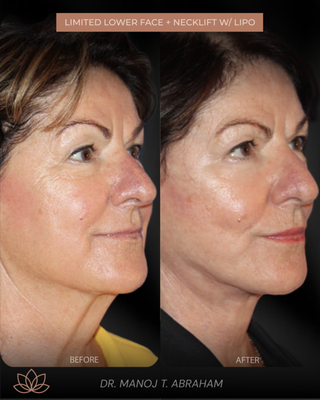 Limited Lower Face & Necklift - A lifted jawline can change everything. This beautiful patient came to Dr. Abraham wanting a more defined profile and a smoother, younger looking neck.

Her result shows what a limited lower facelift paired with a neck lift and liposuction can achieve when the goal is natural refinement, not dramatic distortion.

Along with her lower face and neck work, she also had subtle eyelid rejuvenation and skin resurfacing. Each step was tailored to keep her looking like herself, simply refreshed.

If you are noticing sagging at the jawline or fullness under the chin, this is one of our most effective solutions for long lasting, elegant results.

Ready to explore your options? Send us a message or tap the link in our bio to schedule a private consultation with Dr. Abraham.