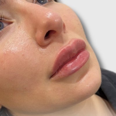 Perfect Pout - Get Your Perfect Pout! 💋

Enhance your lips with our professional lip filler treatments for a fuller, more defined pout. Using hyaluronic acid-based fillers, we customize your look for natural, balanced results.

✨ Plump, Contoured, and Hydrated Lips
✨ Quick, Safe, and Minimal Downtime

Book your consultation today!