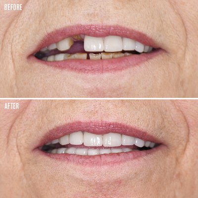 Before & Afters - Explore real patient transformations from 360 Dental. These cases highlight treatments including crowns, restoration of decayed or discolored teeth, cosmetic smile improvements, and full anterior rehabilitation.
Our approach combines advanced diagnostics, precision restorative dentistry, and aesthetic detail to deliver strong, natural-looking, long-lasting results.
From functional repairs to cosmetic upgrades, every smile is designed for health, durability, and confidence. Before & Afters - Explore real patient transformations from 360 Dental. These cases highlight treatments including crowns, restoration of decayed or discolored teeth, cosmetic smile improvements, and full anterior rehabilitation.
Our approach combines advanced diagnostics, precision restorative dentistry, and aesthetic detail to deliver strong, natural-looking, long-lasting results.
From functional repairs to cosmetic upgrades, every smile is designed for health, durability, and confidence.