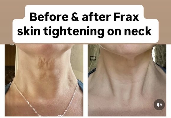 Neck treatment - 🚨 SAN ANTONIO: Melt Away Your “Turkey Neck” & Double Chin — No Surgery Needed 🚨
Reveal a smoother, slimmer jawline with our Turkey Neck Rescue Treatment — now paired with a BONUS Red Light Therapy session.
This is for you if:
✅ You’re tired of saggy, loose neck skin
✅ You hate your double chin in photos
✅ You want a safe, non-invasive way to lift & contour your lower face
✨ Lumyn Medspa
📍 18730 Stone Oak Parkway, Suite 106, San Antonio, TX 78258 Neck treatment - 🚨 SAN ANTONIO: Melt Away Your “Turkey Neck” & Double Chin — No Surgery Needed 🚨
Reveal a smoother, slimmer jawline with our Turkey Neck Rescue Treatment — now paired with a BONUS Red Light Therapy session.
This is for you if:
✅ You’re tired of saggy, loose neck skin
✅ You hate your double chin in photos
✅ You want a safe, non-invasive way to lift & contour your lower face
✨ Lumyn Medspa
📍 18730 Stone Oak Parkway, Suite 106, San Antonio, TX 78258