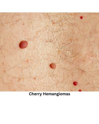 cherry Hemangiomas - Cherry Hemangiomas removal cherry Hemangiomas - Cherry Hemangiomas removal