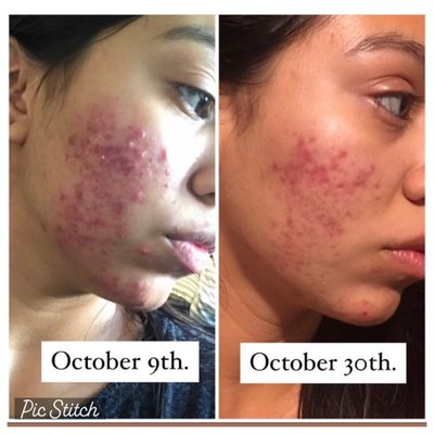 Acne - My lovely client suffered with Cystic Acne for many years. Mary Jane went to numerous estheticians and dermatologists. Unfortunately she had no success. We did a series of variation chemical peels, acne facials, Microneedling . We put her on a strict regimen and supplements. Her acne is now under control. Acne - My lovely client suffered with Cystic Acne for many years. Mary Jane went to numerous estheticians and dermatologists. Unfortunately she had no success. We did a series of variation chemical peels, acne facials, Microneedling . We put her on a strict regimen and supplements. Her acne is now under control.