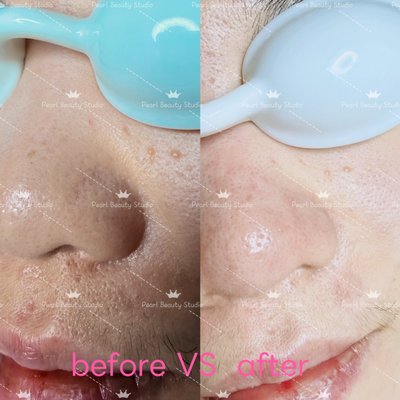 deep clean and hydrating - the treatment contains extraction, face massage, and shoulder massage. enjoy the complete process. deep clean and hydrating - the treatment contains extraction, face massage, and shoulder massage. enjoy the complete process.