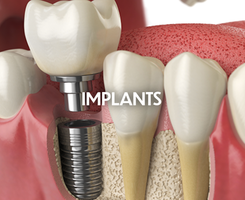 Dental Implants - Dental implants are a way that we can replace missing teeth.  Titanium is fused with bone to create a tooth root replacement system.  The implant crown is then connected to the implant below the gumline.  Implants allow us to replace a single tooth, or multiple teeth with multiple implants if needed.