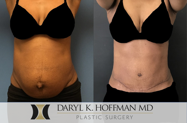 Abdominoplasty - A careful diet and exercise program may not be enough to keep a person looking trim and slender, especially after pregnancy or significant weight changes. Dr. Daryl K. Hoffman offers abdominoplasty, often called a tummy tuck, to give San Jose, Palo Alto, Campbell, and other Bay Area residents tightened and toned midsections. This procedure tightens abdominal muscles and excess skin, and reduces fat deposits to combat a sagging mid-body appearance. Women and men who choose a tummy tuck from Dr. Hoffman typically see body-sculpting surgical results that even the healthiest lifestyle often cannot provide.

To take the next step toward a firmer, slimmer abdomen, request your consultation with Dr. Hoffman online or call us at (650) 209-6277 (Palo Alto) or (408) 357-2005 (Campbell) to schedule an appointment.