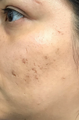 Microneedling - Microneedling patient