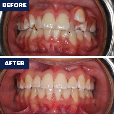 Orthodontics Before and After Transformations! - At Dentist of Long Beach, we offer the highest quality orthodontic treatments. We offer Invisalign, metal braces, porcelain braces and retainers. Call us to schedule a consultation! (562) 568-7467 https://dentistlongbeach.com/ Orthodontics Before and After Transformations! - At Dentist of Long Beach, we offer the highest quality orthodontic treatments. We offer Invisalign, metal braces, porcelain braces and retainers. Call us to schedule a consultation! (562) 568-7467 https://dentistlongbeach.com/